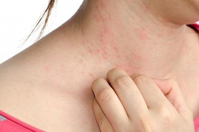 Psoriāzes saasināšanās izpaužas kā izsitumi uz ādas un stiprs nieze